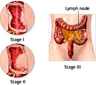 Gene expression for advanced bowel cancer