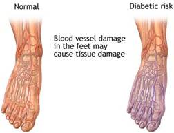 Diabetic Foot