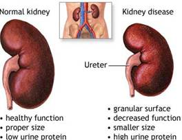 Kidney Failure