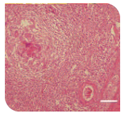 Coligranuloma